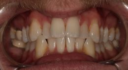 Belpree Dental | Dental Cleanings, Ceramic Crowns and Sleep Apnea