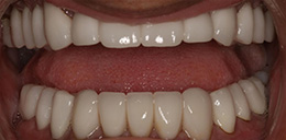 Belpree Dental | Root Canals, Digital Impressions and CBCT