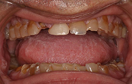 Belpree Dental | Dental Cleanings, Digital Impressions and Emergency Treatment