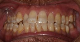 Belpree Dental | Veneers, Digital Radiography and Sleep Apnea