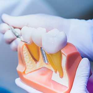 Dental Implants Dentist in Amarillo